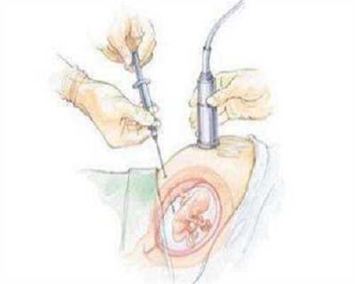 代生要多少钱:做试管婴儿如何取到又多又健康的精子