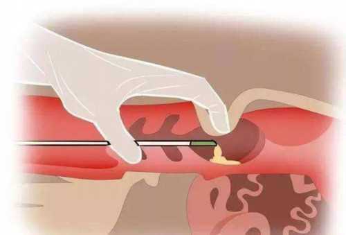 冻胚移植前是否要打黄体酮？代生孩子网移植冻胚前的准备工作要做好