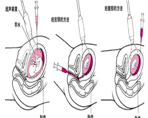有携带地贫基因做试管二代？地贫携带者做试管婴儿可以吗